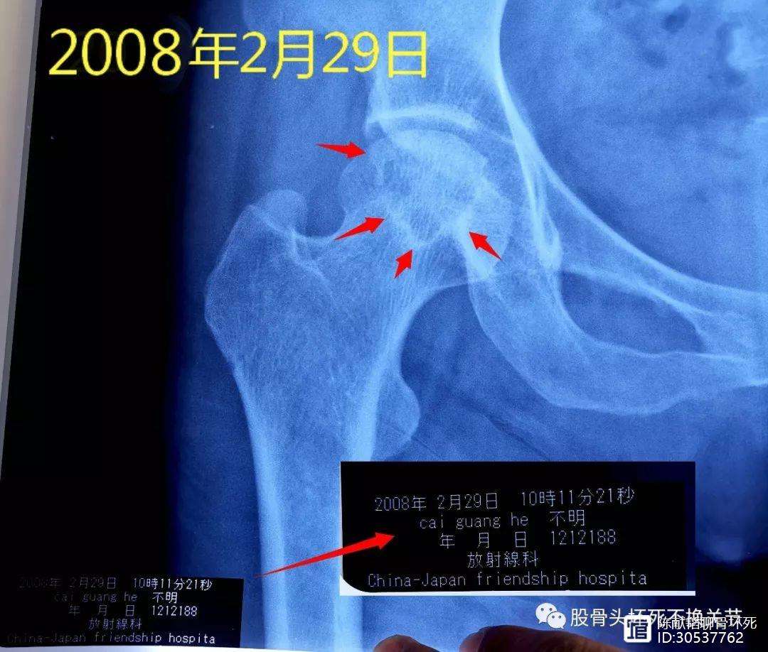 邯郸人工骨头医保报销多少(人工骨头医保报销多少比例)